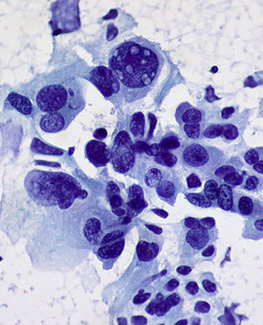 Tumor cell biology